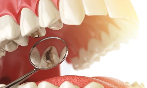 283068-trocar-restauracao-nos-dentes-o-que-preciso-saber