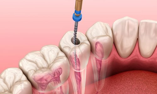 ENDODONTIA-tratamento-de-canal