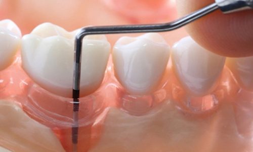 Periodontal-Disease